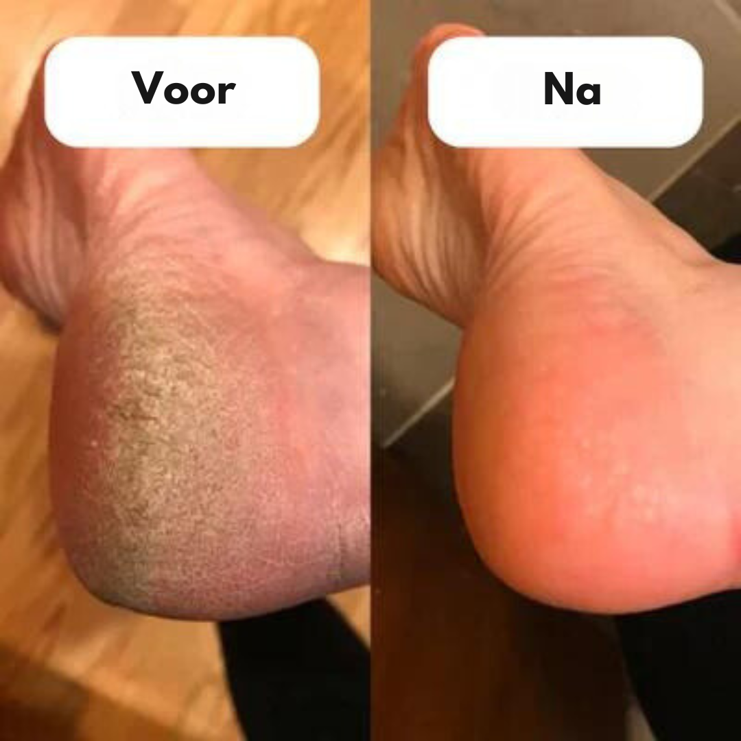 FeetCleanPro™ | Elektrische Eeltverwijderaar